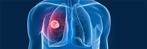 В условиях пандемии скрининг рака лёгкого в Казахстане становится важнейшим фактором выявления и лечения болезни