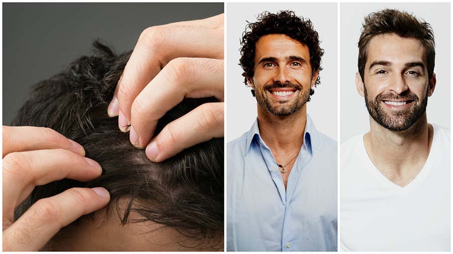 Технология пересадки волос DHI – натуральный эффект без шрамов