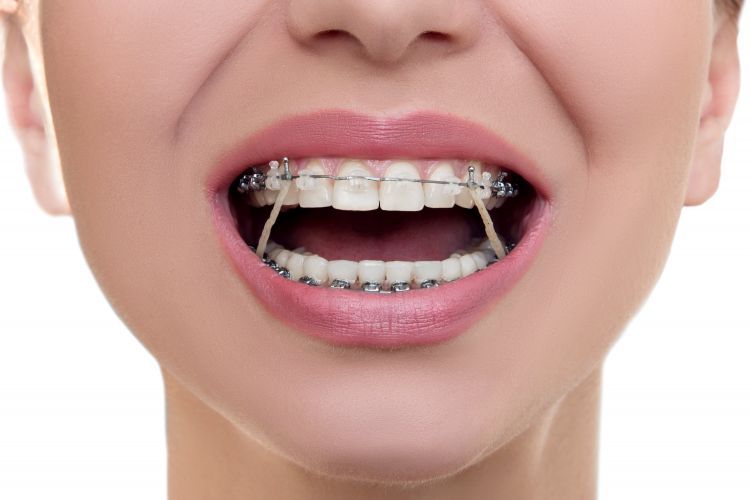 Как выровнять зубы без брекетов?