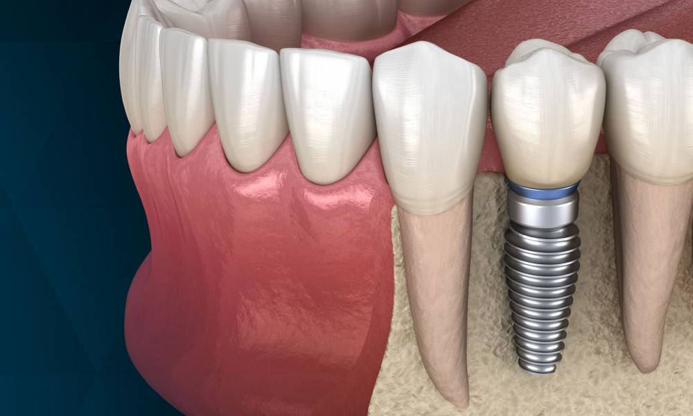 Импланты зубов: Революция в стоматологии и улучшение качества жизни